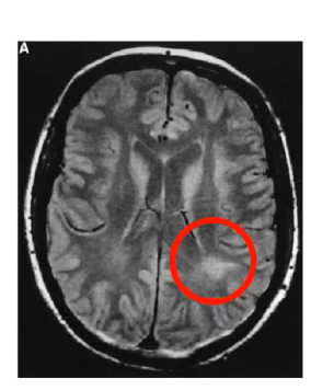 <p>____ syndrome presents as agraphia, right left confusion ( used to write with right hand but now thinks htey are left handed) , inability to understand and use numbers, typically caused by damage to ______ ______ lobule</p>