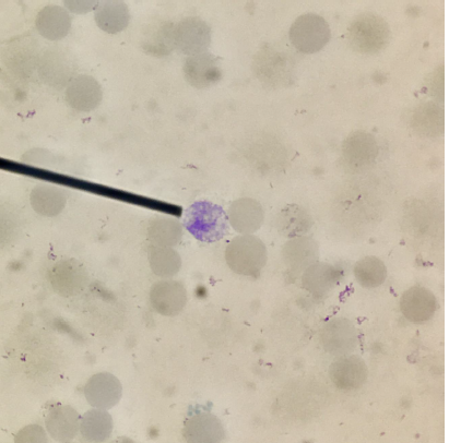 <p>TRUE or FALSE</p><p>This cell is included in the count under this supravital staining test</p>