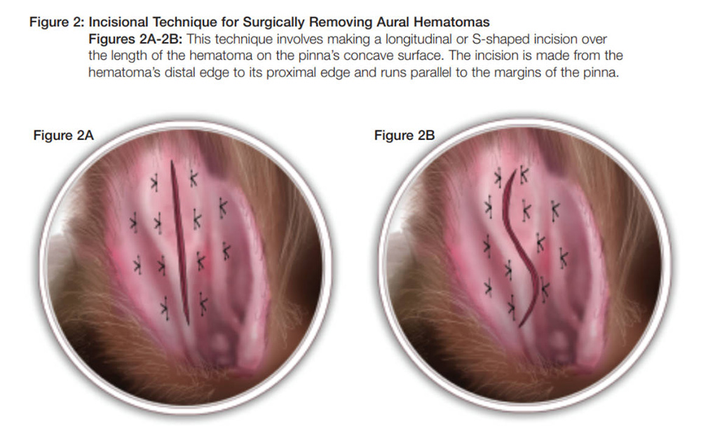 <ol><li><p>Needle Aspiration &amp; local corticosteroids.</p></li><li><p>Passive Drain: Penrose drain placed through incisions, cavity lavaged, sutures secure the drain. Left for 2 weeks.</p></li><li><p>Active Drain: Butterfly catheter inserted, creating suction with a vacuum tube, secured with sutures.</p></li><li><p>Incisional Drainage: S-shaped incision removes the clot. Mattress sutures with gauze stents prevent over tightening. Bandage ear, remove sutures after 2 weeks</p></li></ol><p></p>