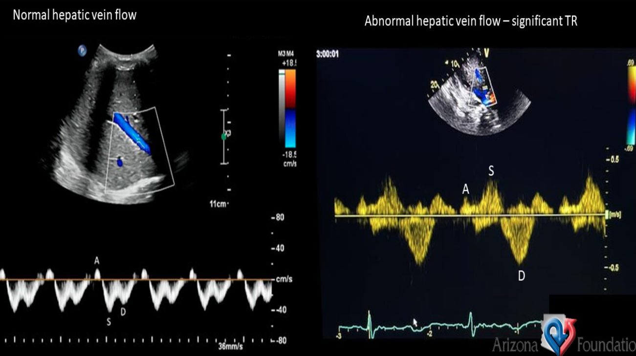 <p>Abnormal HV flow due to severe TR </p>