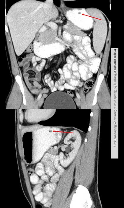 <p>How do ulcers appear on contrast studies?</p>