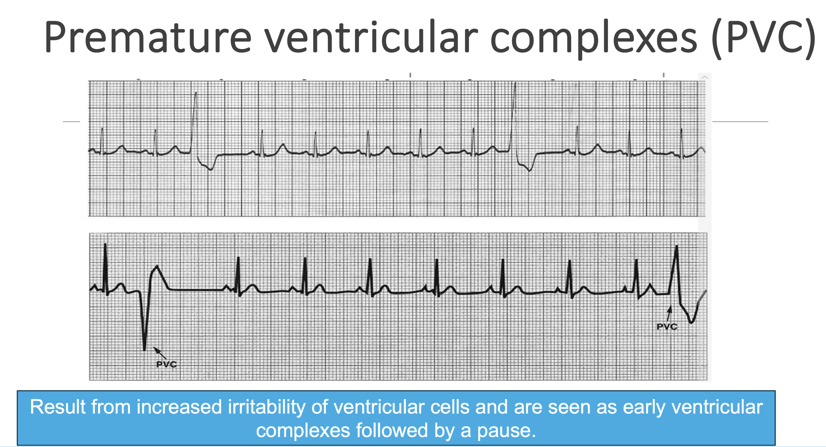 <p>Premature ventricular complexes (PVC)</p>