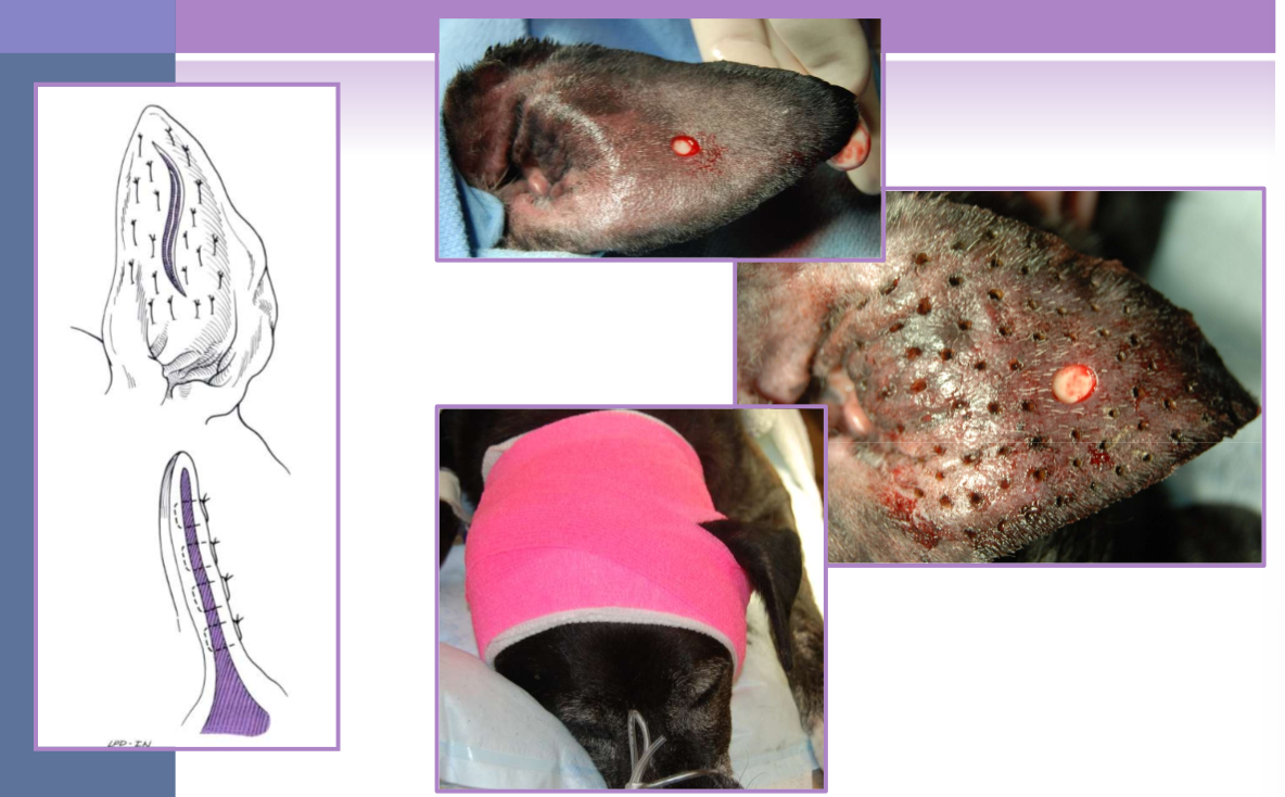 <ul><li><p>collection of blood, serum, or both in the pinna </p></li><li><p>forms second degree longitudinal planar fracture of articular cartilage </p></li><li><p>exacerbated with shaking of the head </p></li><li><p>numerous techniques for repair </p><ul><li><p>goal: obliterate dead space </p></li><li><p>incision and suture, CO2 laser </p></li><li><p>infusion of steroid </p></li></ul></li><li><p>common with ear infections shaking head </p></li></ul><p></p>