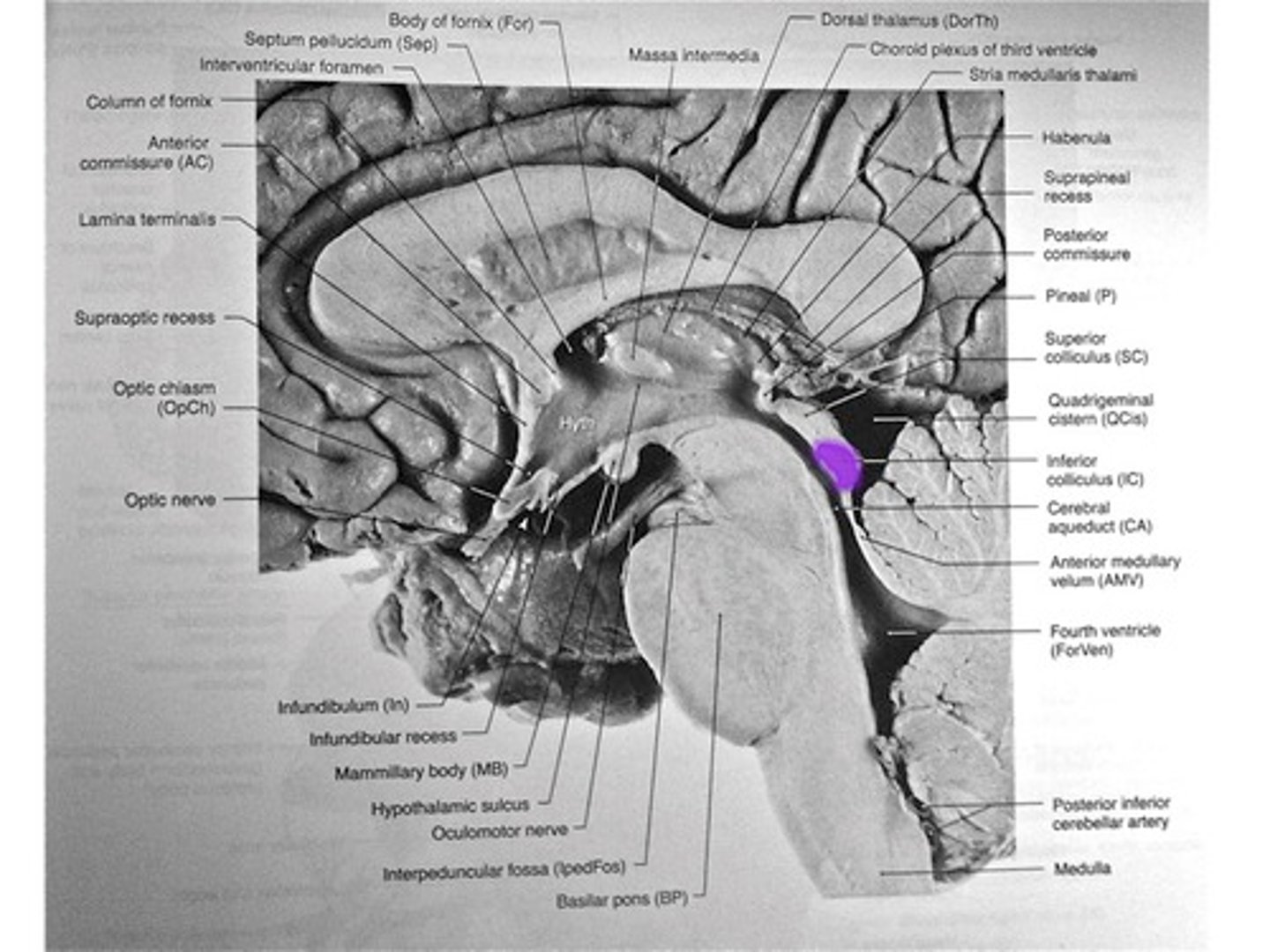 <p>- Deals with Hearing Area of Midbrain</p><p>- Location of sounds</p>