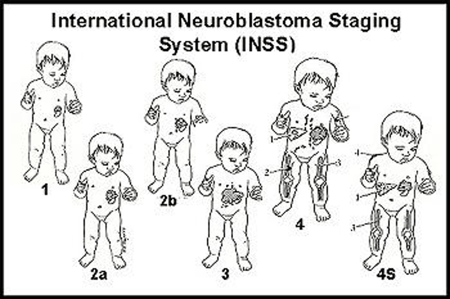 <p>INSS is based on surgical results, while INRGSS is based on diagnostic imaging/testing.</p>
