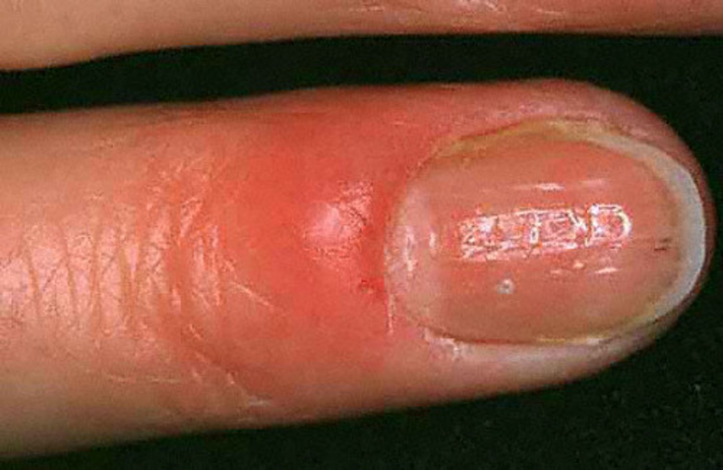 <p>(par-uh-NIK-ee-uh) A diseased state or infection around the nail (រលាកស្បែកជុំវិញក្រចក)</p>