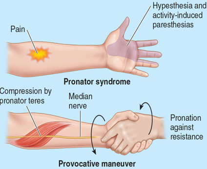 <p>Pronator Syndrome (2nd most common entrapment) is compression of median nerve proximal to where the</p>
