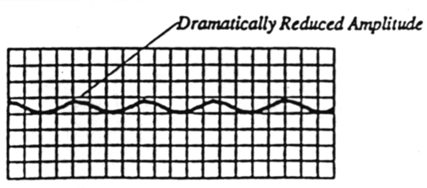 <p>Significant delay in upstroke</p><p>Absent or low-amplitude</p><p>Equal upslope and down slope time</p>