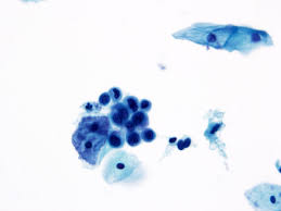 <p>Petites cellules immatures hyperchromatiques évoquant HSIL mais sans critères complets.</p><p>1) diagnostic principal</p><p>2) dd pertinents</p><p>3) clés d’exclusion</p><p>4) conduite</p><p>5) risque HSIL</p>