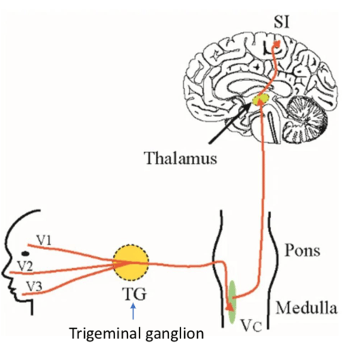 <p>- Brief recurring episodes of severe pain</p><p>- Lasting seconds to minutes in V2/V3</p>