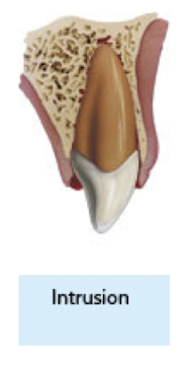 <p>which type of traumatic luxation injury:</p><p>- Apical displacement of tooth into the alveolar bone</p><p>- Tooth is driven into the socket, compressing the PDL</p><p>- Tooth appear to be shortened or missing</p><p>- Severe type of luxation injury</p><p>Treatment:</p><p>- Reposition the tooth with orthodontic or surgical extrusion</p><p>- Prognosis is poor</p><p>- High rate of Pulp Necrosis (96%)</p><p>and Root Resorption</p><p>- Initiate endodontic treatment at 2 weeks</p><p>- Recommend Ca(OH)2 for up to 4</p><p>weeks</p>