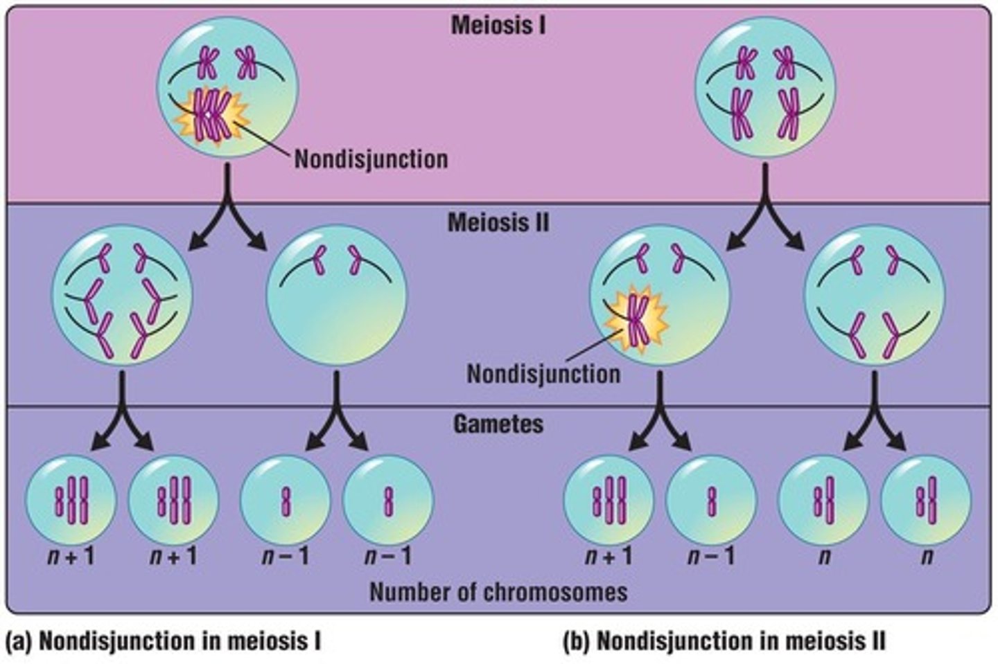 <p>A genetic condition caused by an extra 21st chromosome, commonly known as Down syndrome.</p>