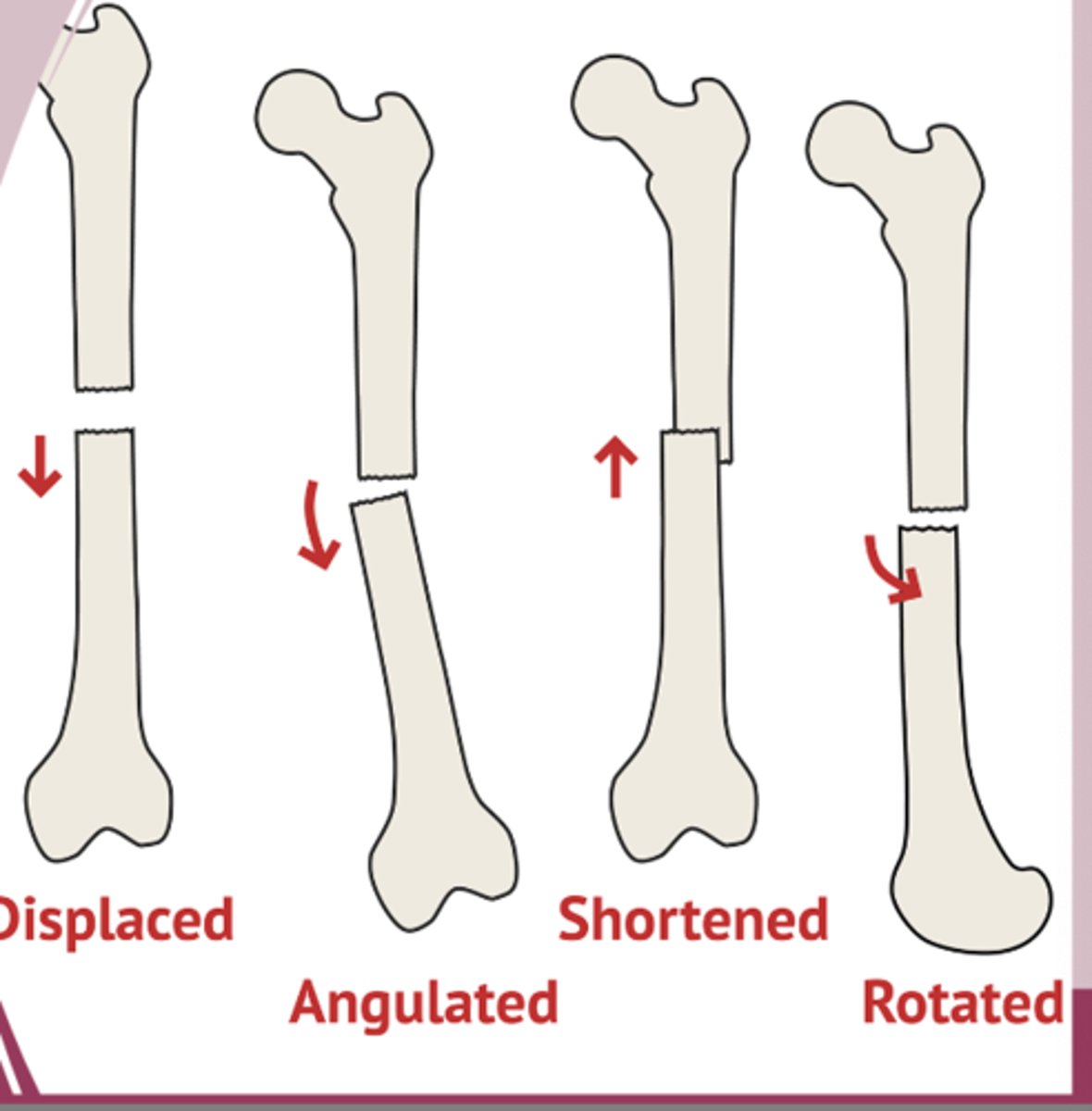 <p>fracture displacement</p>