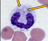<p>Darker blue cytoplasm with foamy and indistinct vacuoles, ± ring nuclei</p>