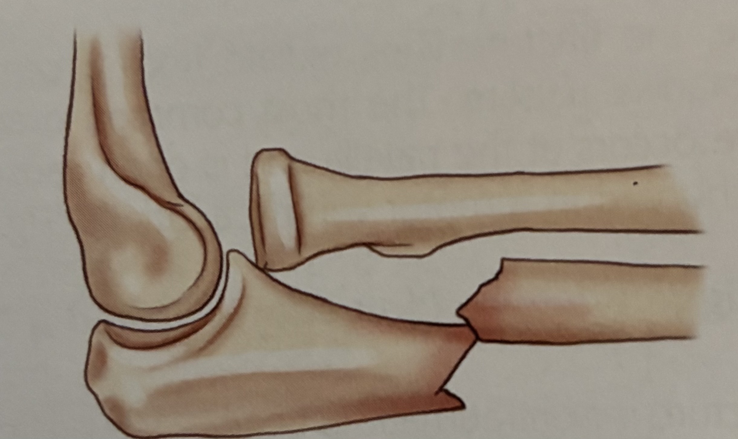 <p>What type of fracture is this?</p>