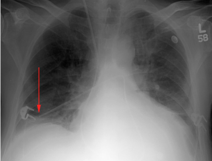 <p>Is this a satisfactory Swan Ganz catheter placement?</p>