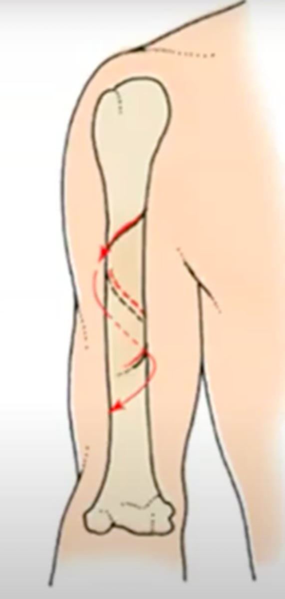 <p>a fracture in which the bone has been twisted apart</p><p>usually occurs when force is exerted on a bone while one end is stationary and the other end twists</p><p>sometimes associated with physical abuse, especially young children and elderly</p>