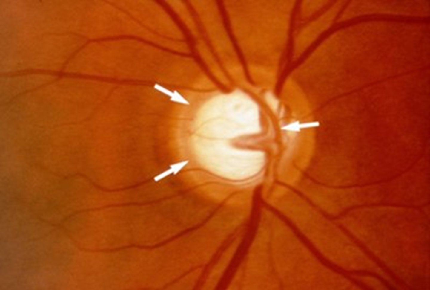 <p>a prominent clinical landmark of the retina. It is constituted of the ganglion cell axons as they leave the eye to form the optic nerve.</p>