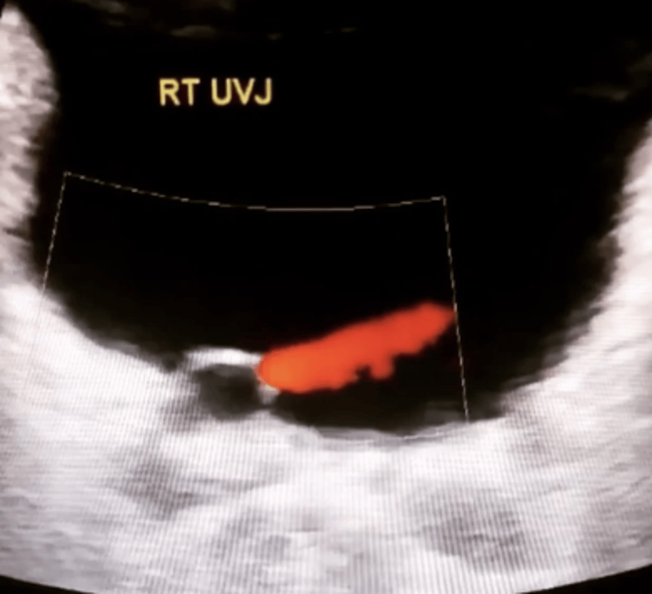 <p>b. Ureterocele</p>