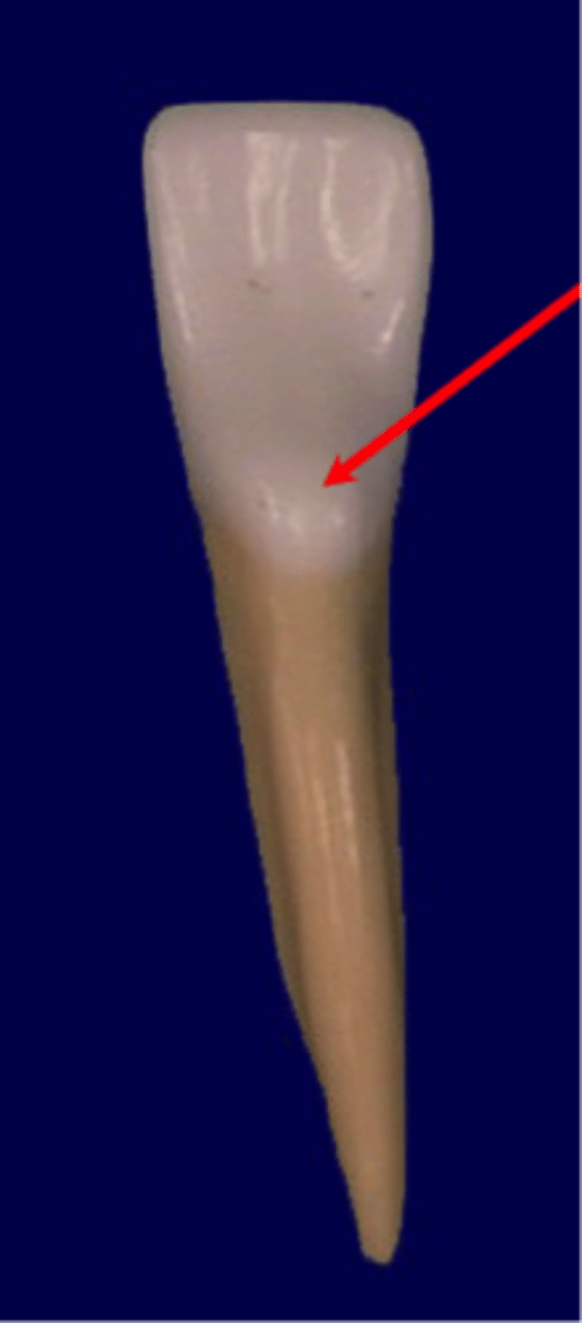 <p>bulge in lingual cervical third of anterior teeth</p>