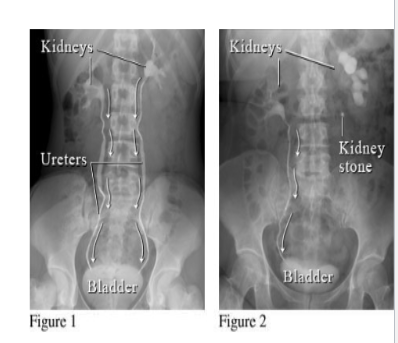 <p>Etiology:</p><ul><li><p><span><span>More common in men ( 20-60 years) and associated with sedentary lifestyle.</span></span><br></p></li></ul><p>Patient Presentation:</p><ul><li><p><span><span>patient complains of severe intermittent pain ( ureteric colic) which may be felt from loin to groin , proximal anterior aspect of thigh or external genitalia . (T11- L2).</span></span></p></li><li><p><span><span>May also have blood in the urine ( hematuria )</span></span><br></p></li></ul><p></p><p>Treatment:</p><ul><li><p><span><span>Lithotripsy sends a shock wave that breaks the stone into</span></span><br><span><span>fragments which then pass in the urine.</span></span></p></li></ul><p></p>
