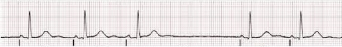 <p>absence of cardiac cycle(s); P-P intervals still march out across the rhythm once activity resumes</p>