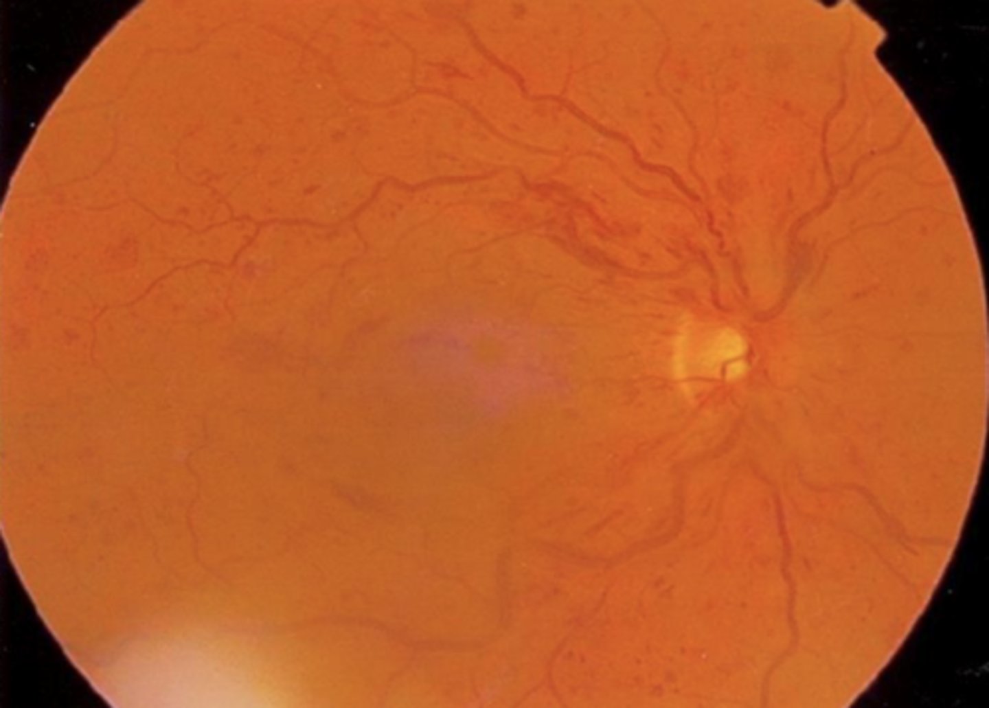 <p>1. dot-blot and flame-shaped hemes</p><p>2. intraretinal edema</p><p>3. various degrees of macular + ONH edema</p>