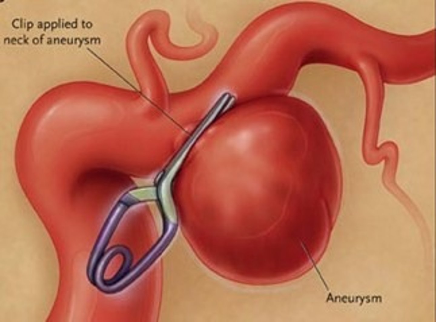<p>surgical method to isolate an aneurysm from the rest of the circulatory system by placing a small clip across its neck</p>