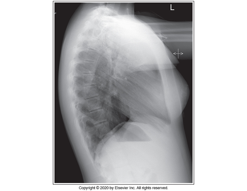 <p>Identify the main problem of the image below (left lateral chest)</p><p>Tilt</p><p></p><p>Humeri not elevated.</p><p>&nbsp;</p><p>CR angulation</p><p>&nbsp;</p><p>Rotation</p>