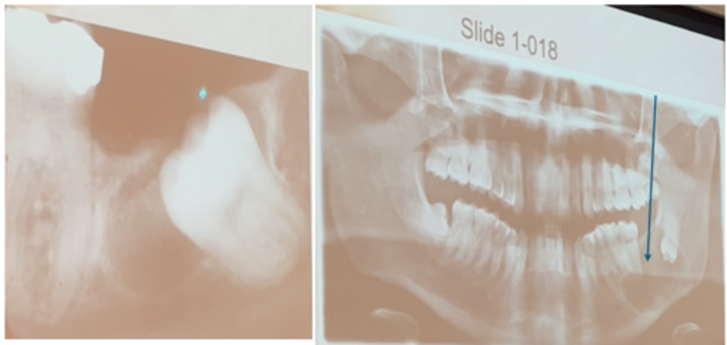 <p>unilocular.</p><p>Unilocular means having one compartment or unit that is well defined. This term is often used to describe a radicular cyst. </p><p>Coalescence refers to the process by which parts of a whole join together, or fuse, to make one. </p><p>Diffuse describes a lesion with ill-defined borders, making it impossible to detect the exact parameters of the lesion. </p><p>A multilocular lesion has also been described as “soap bubble”–like; the lobes appear to fuse together to make up the lesion.</p>