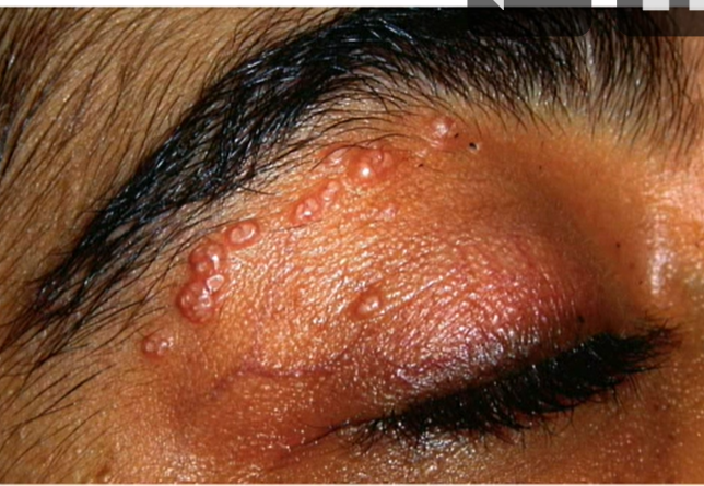 <ol><li><p><strong><u>follicular conj</u></strong></p></li><li><p><strong><u>lid margin lesions </u></strong></p><ol><li><p><strong><u>umbilicated, waxy, flesh colored </u></strong></p></li></ol></li></ol><p></p>