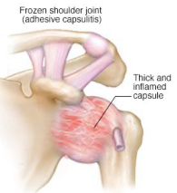 <p><strong>Adhesive Capsulitis (Frozen Shoulder): Background</strong></p><p>-Global limitation of _____ and _________ shoulder ROM</p><p>-Epidemiology: </p><ul><li><p>5th-6th decades</p></li><li><p>F _ M</p></li><li><p>__ and other systemic illness are at an increased risk </p></li></ul><p>-Etiology:</p><ul><li><p>Idiopathic</p></li><li><p>Secondary to shoulder ________</p></li></ul><p></p>