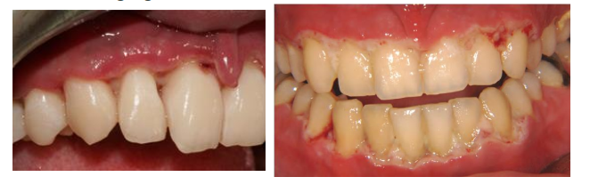 <p>Ulcerated and necrotic papillae and marginal gingiva </p><ul><li><p>Papillae and gingival margin have a “punched out” or “cratered” appearance</p></li><li><p>Pseudomembrane = gray layer of tissue covering the necrotic areas of the gingiva </p></li></ul><p></p>