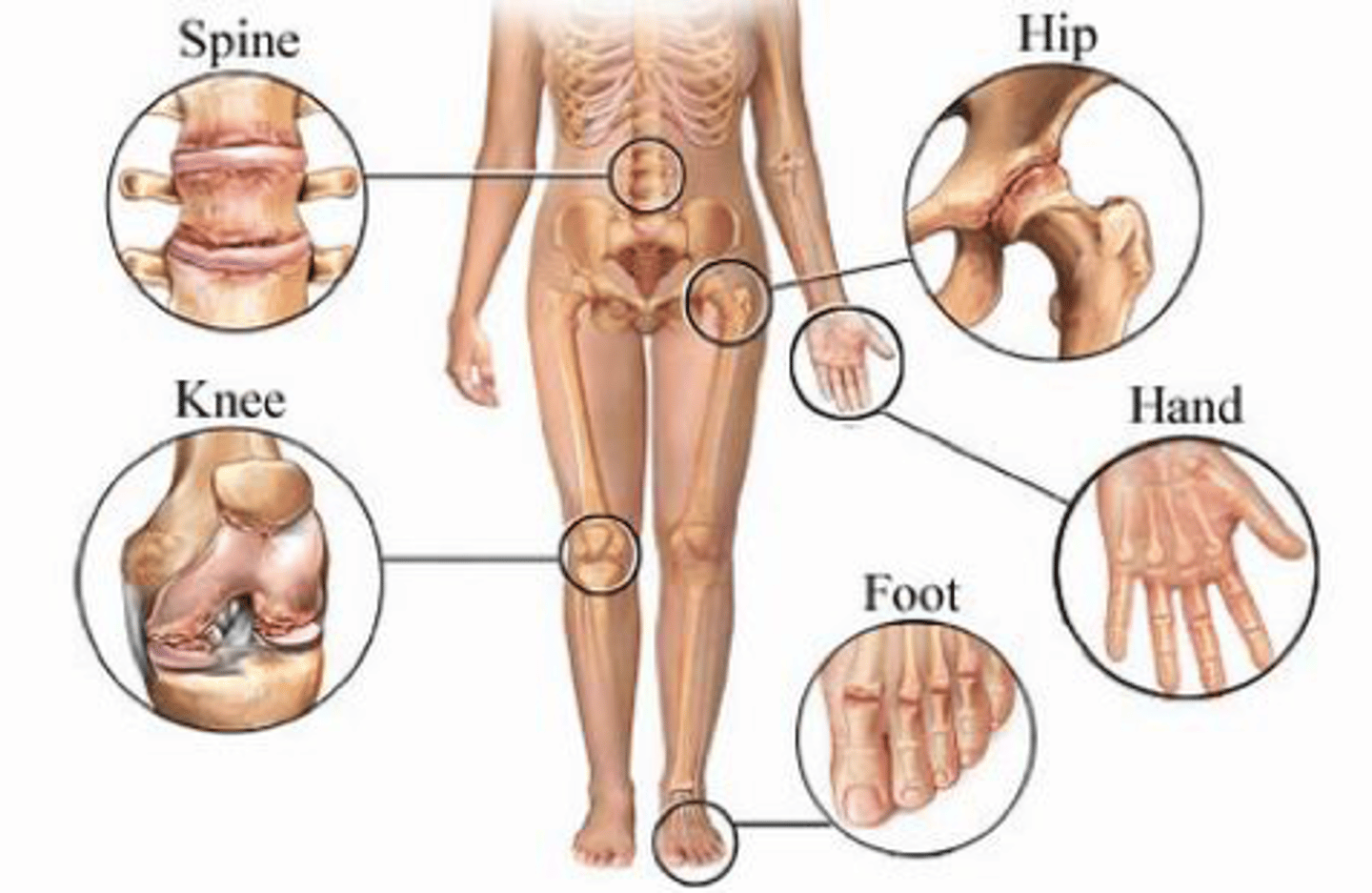 <p>abnormal condition of a joint</p>