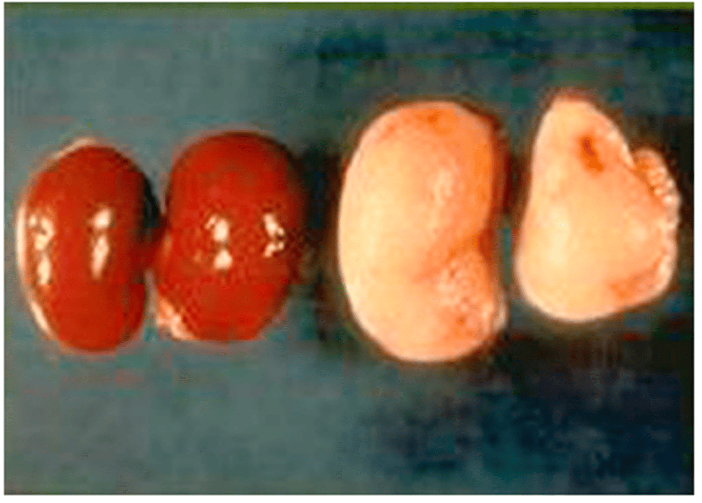 <p>The kidneys on the left are normal hamster kidneys. What do the kidneys on the right represent a classical appearance of ?</p>