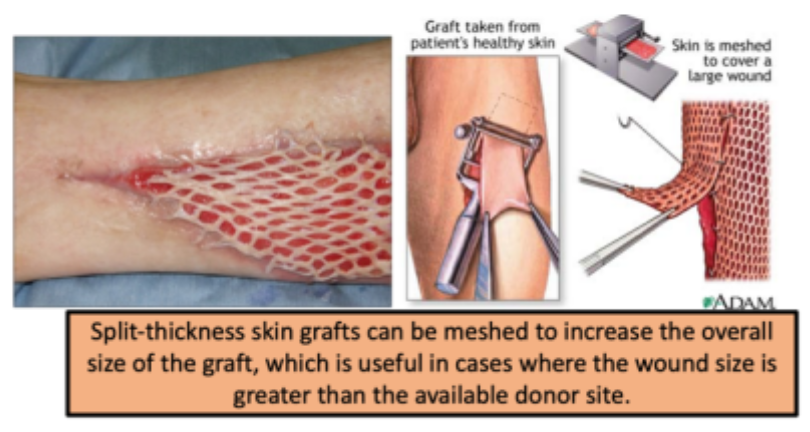 <p>to increase overall size of graft in cases where wound size is greater than the available donor site </p>