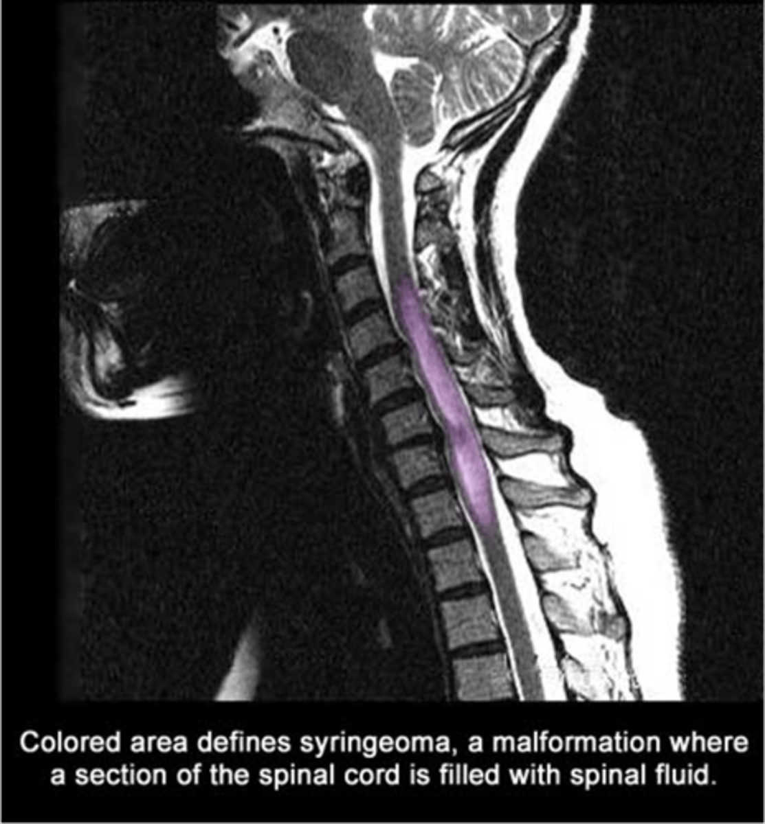 <p>-cyst within spinal cord (fluid filled)<br><br>*Leads to cloak-like distribution of loss of pain and temp sensation</p>