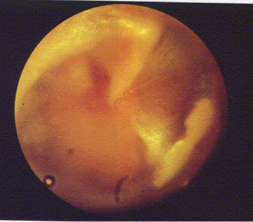 <p><u>disordered otoscopy: middle ear</u></p><p>otosclerosis</p>