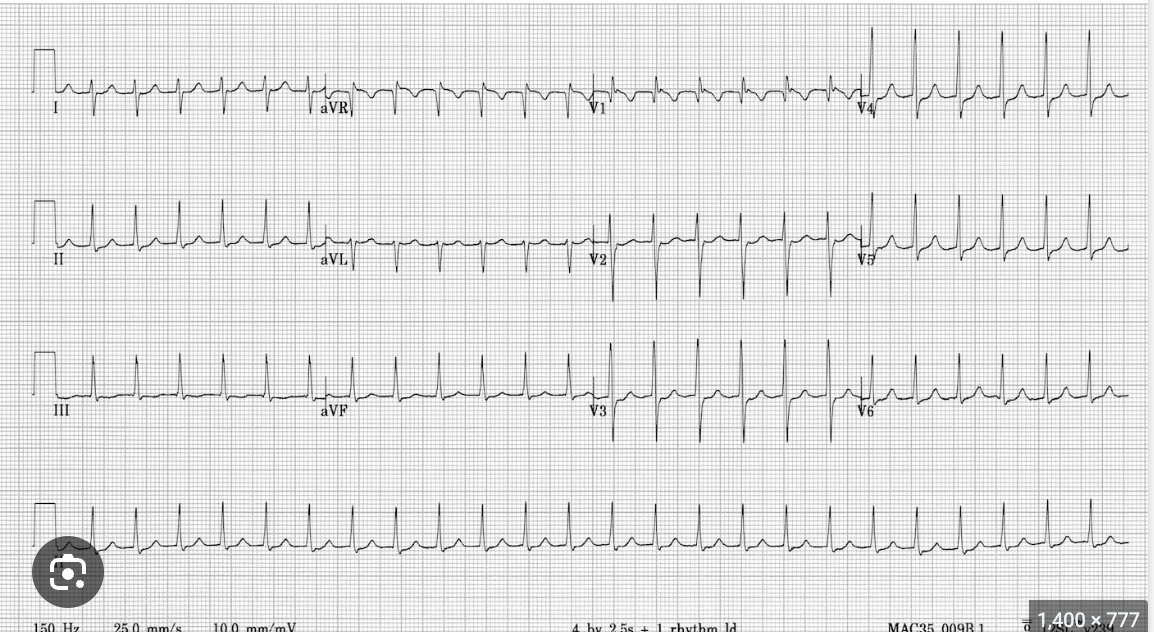 <p>What medication use to treat AVNRT blocks AV nodal conduction and works in about 80% of cases (C/I w/ asthma or COPD)</p>