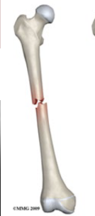 <p>What fracture is this?</p>