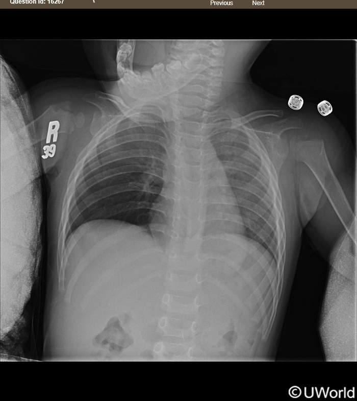 <p>18 month old boy playing with cousin, sudden shortness of breath and wheezing</p>