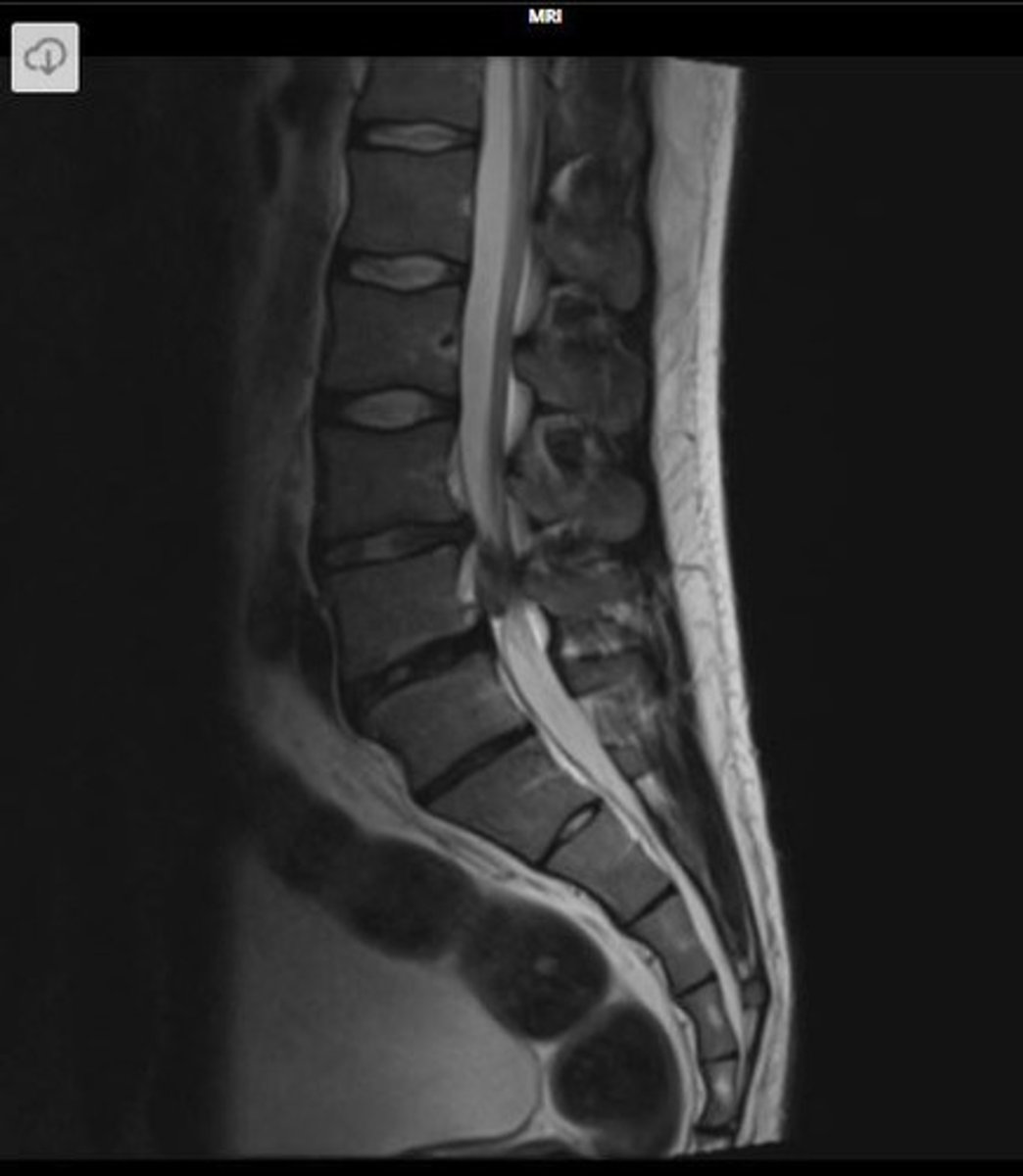 <p>A surgical emergency caused by compression of the cauda equina (nerve roots below conus medullaris)</p>