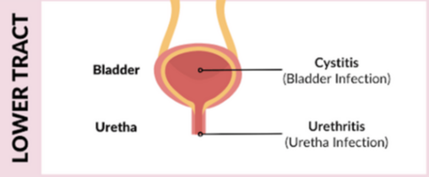 <p>urinary frequency, urgency, dysuria, nocturia, confusion in older patients, can lead to upper UTI,no systemic manifestations</p>