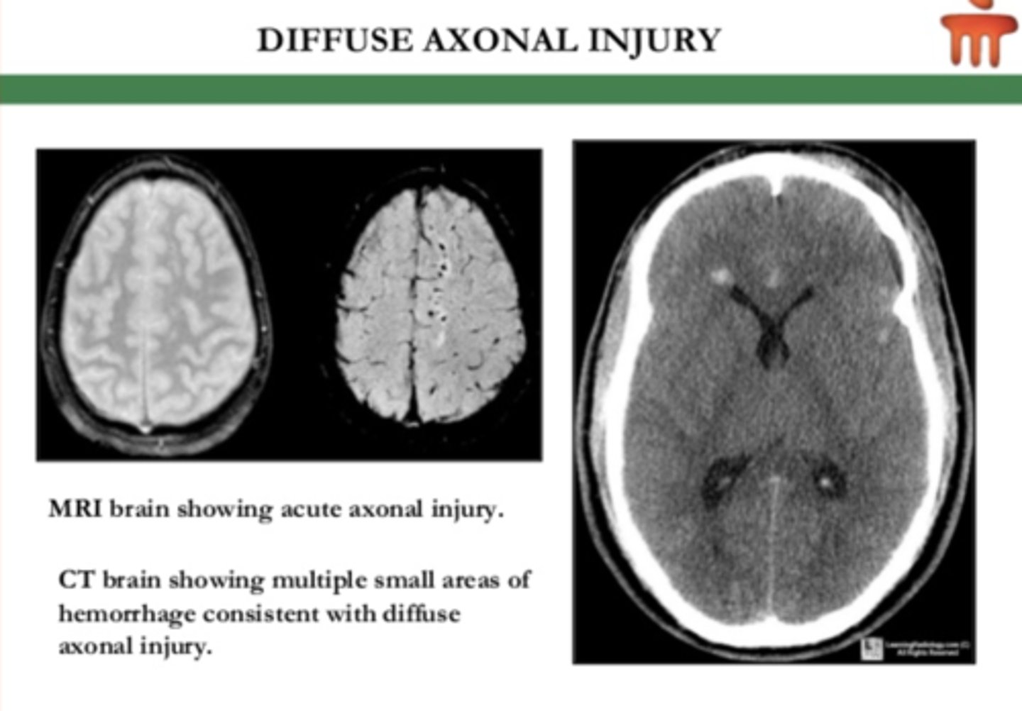 <p>Diffuse axonal injury</p><p>- most significant cause of morbidity in patients with TBI</p><p>- traumatic deceleration</p>