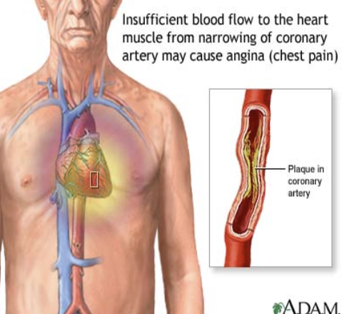 <ul><li><p>When your heart doesn’t get as much blood and oxygen as it needs because one or more of its arteries (coronary arteries) is blocked</p></li><li><p>A warning signal that you are at increased risk of a heart attack, cardiac arrest or sudden cardiac death</p></li></ul>