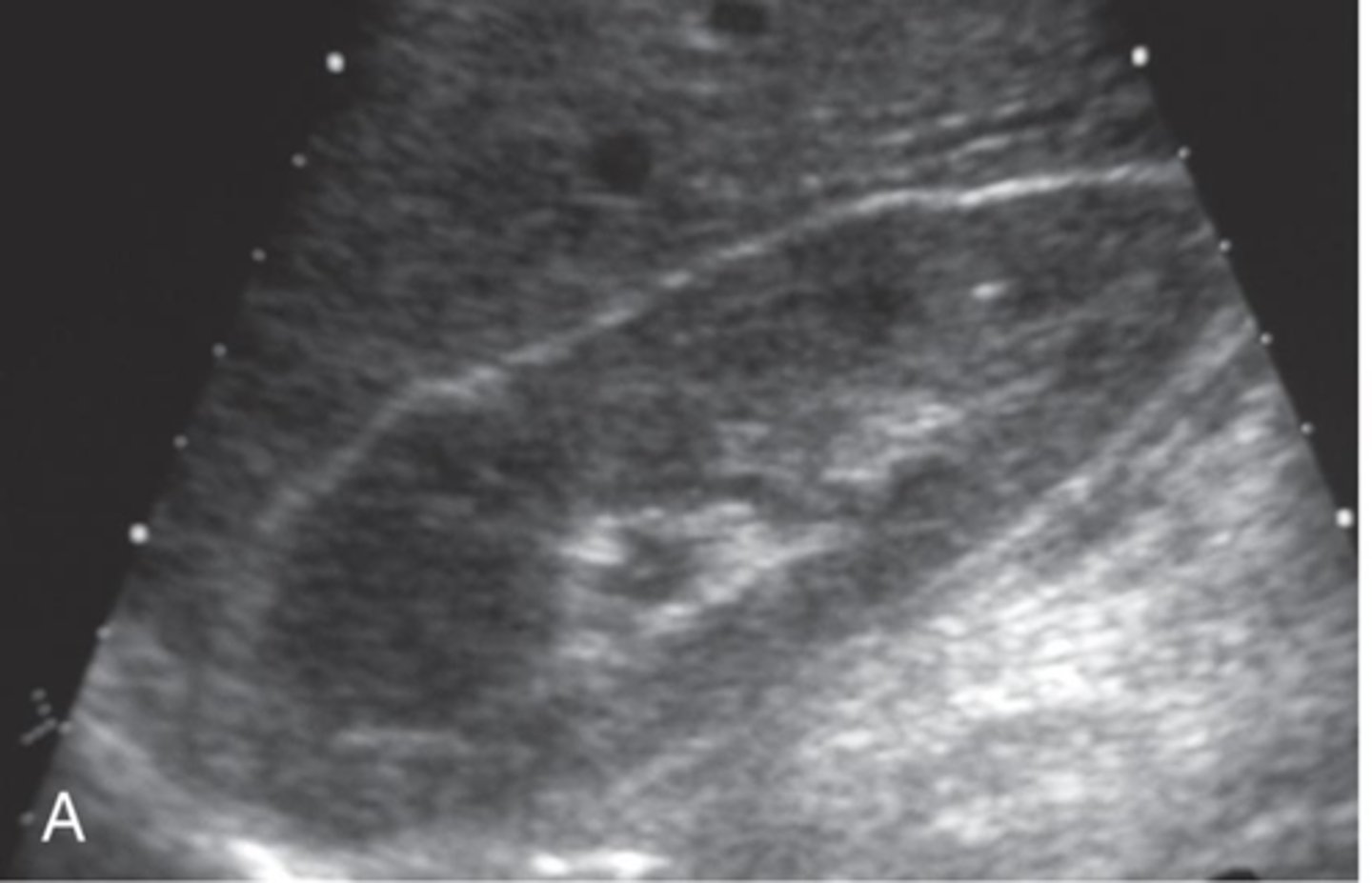 <p>Lymphoma is more common as a ___ invasion with multiple ___ </p>