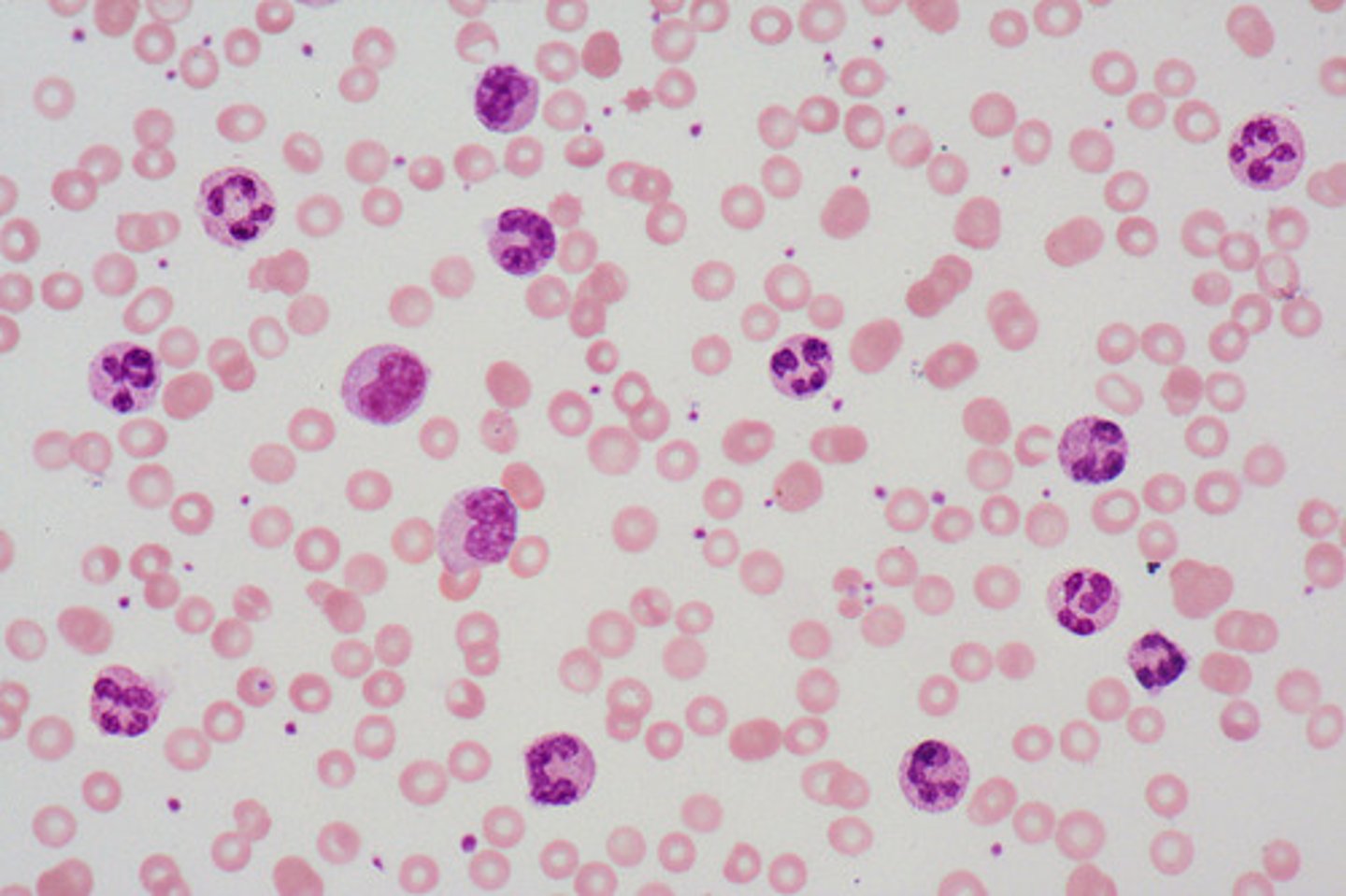 <p><span style="text-decoration:underline">Define this WBC Abnormality</span>:</p><p><strong><em>Increase in Neutrophils in peripheral blood</em></strong></p><p>-<span style="text-decoration:underline">Hx</span>:</p><p>&gt; Infex</p><p>&gt; Cancer</p><p>&gt; Meds</p><p>&gt; Metabolic Disorders</p><p>&gt; Myeloid Neoplasms</p><p>&gt; Constitutional (rare)</p>