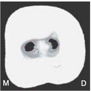 <p><span>non–C-shaped floors</span></p><p><span>one distal canal orifice and one oval or two round mesial canal orifices are present (least common)</span></p>