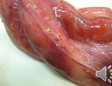 <p>What is this pathology on the umbilical cord?</p>