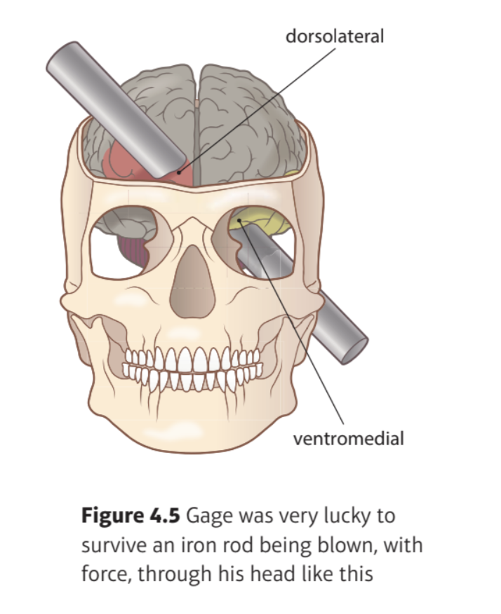 <p>Procedure: Damasio et al. (1994) The Return of Phineas Gage: Clues About the Brain from the Skull of a Famous Patient</p>